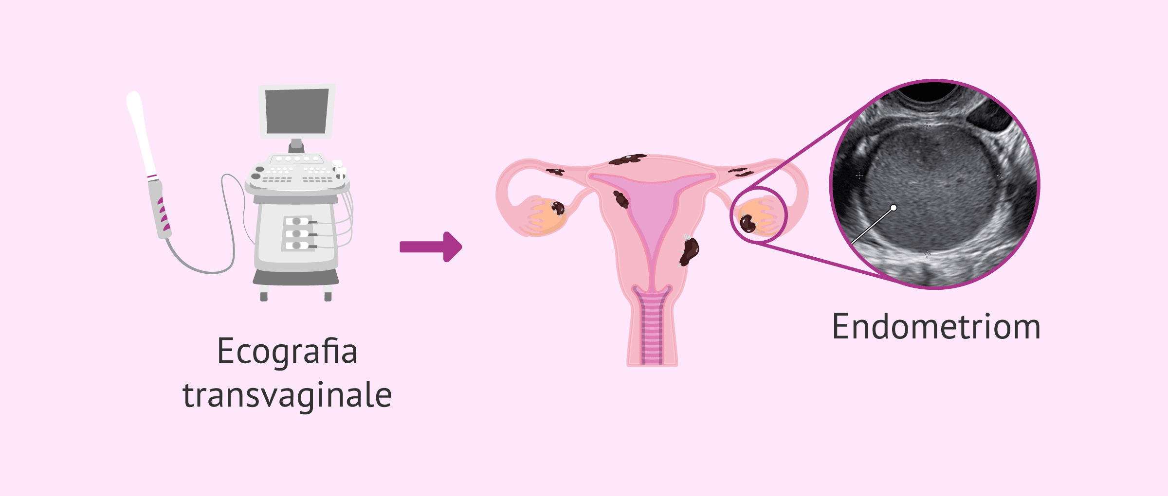 Diagnosi di endometriosi: test analitici e di imaging