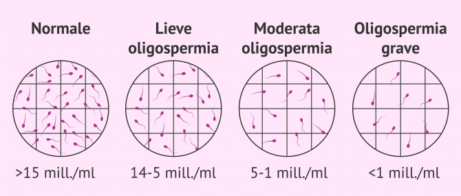 Imagen: Gradi di oligospermia in campioni di sperma