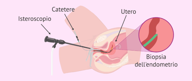 Imagen: Come si esegue lo scratching endometriale?