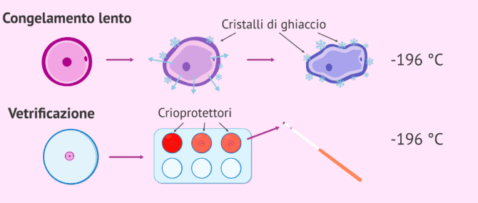 Imagen: Congelamento lento e vitrificazione degli ovuli