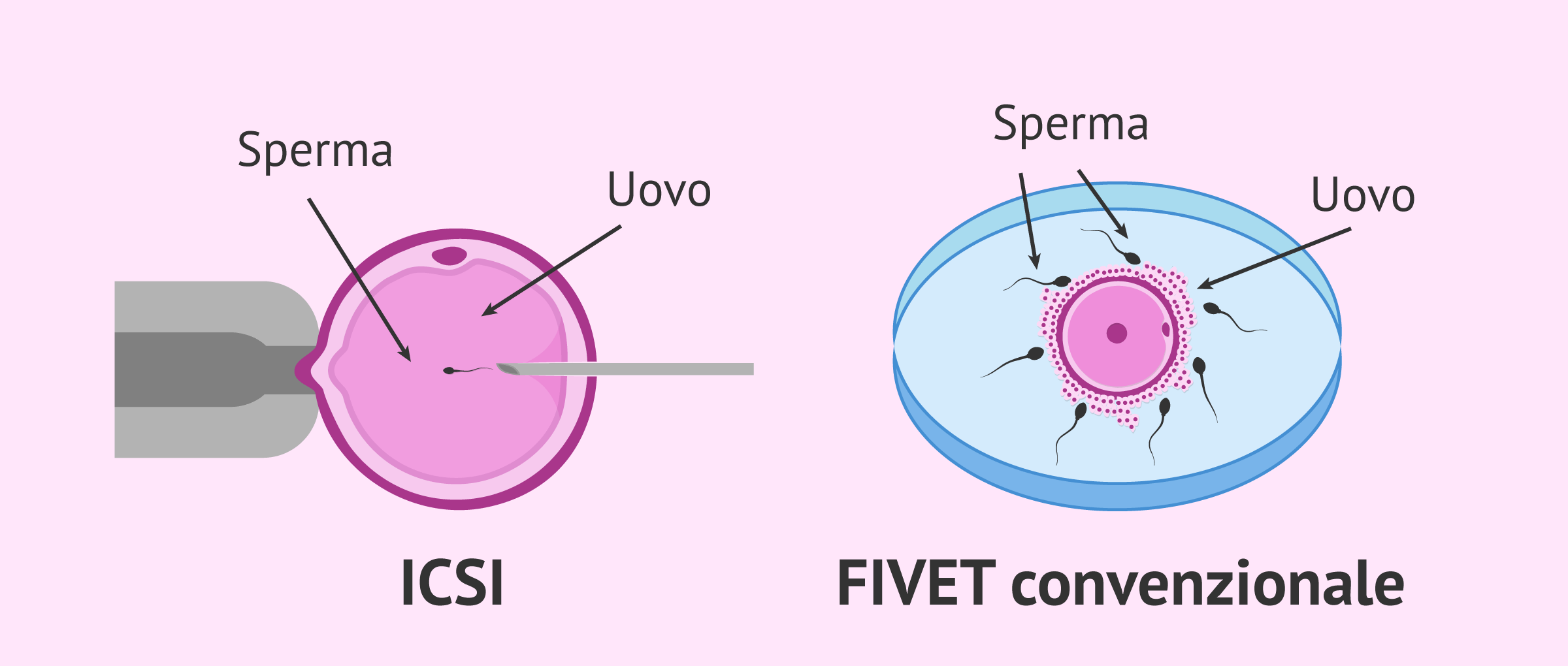 Confronto tra FIVET convenzionale e ICSI
