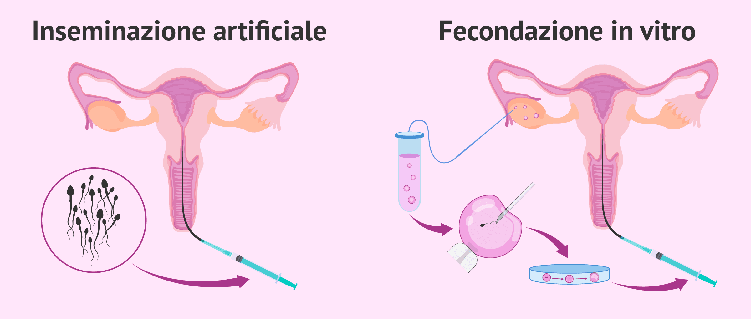 Differenze tra inseminazione artificiale e fecondazione in vitro