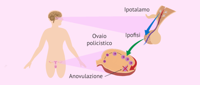 Imagen: Anovulazione nelle donne con PCOS