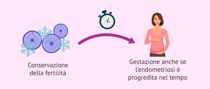 Imagen: Endometriosi e conservazione della fertilità