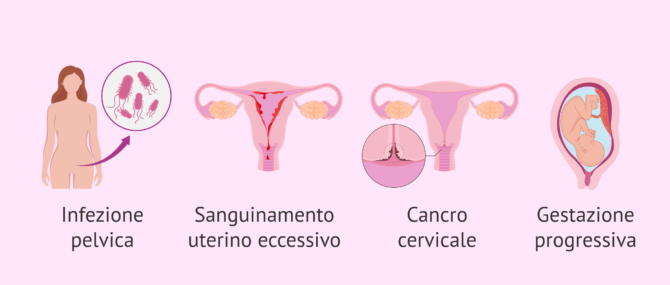 Imagen: Controindicazioni all'isteroscopia