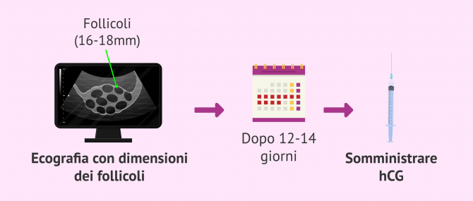 Imagen: Controllo a ultrasuoni e gestione dell'hCG