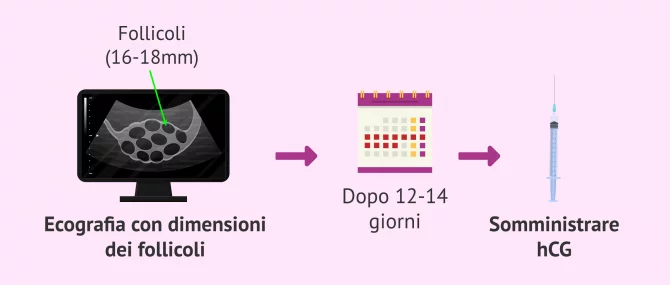 Imagen: Controllo a ultrasuoni e gestione dell'hCG