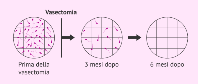 Imagen: Semenogrammi di controllo dopo la vasectomia