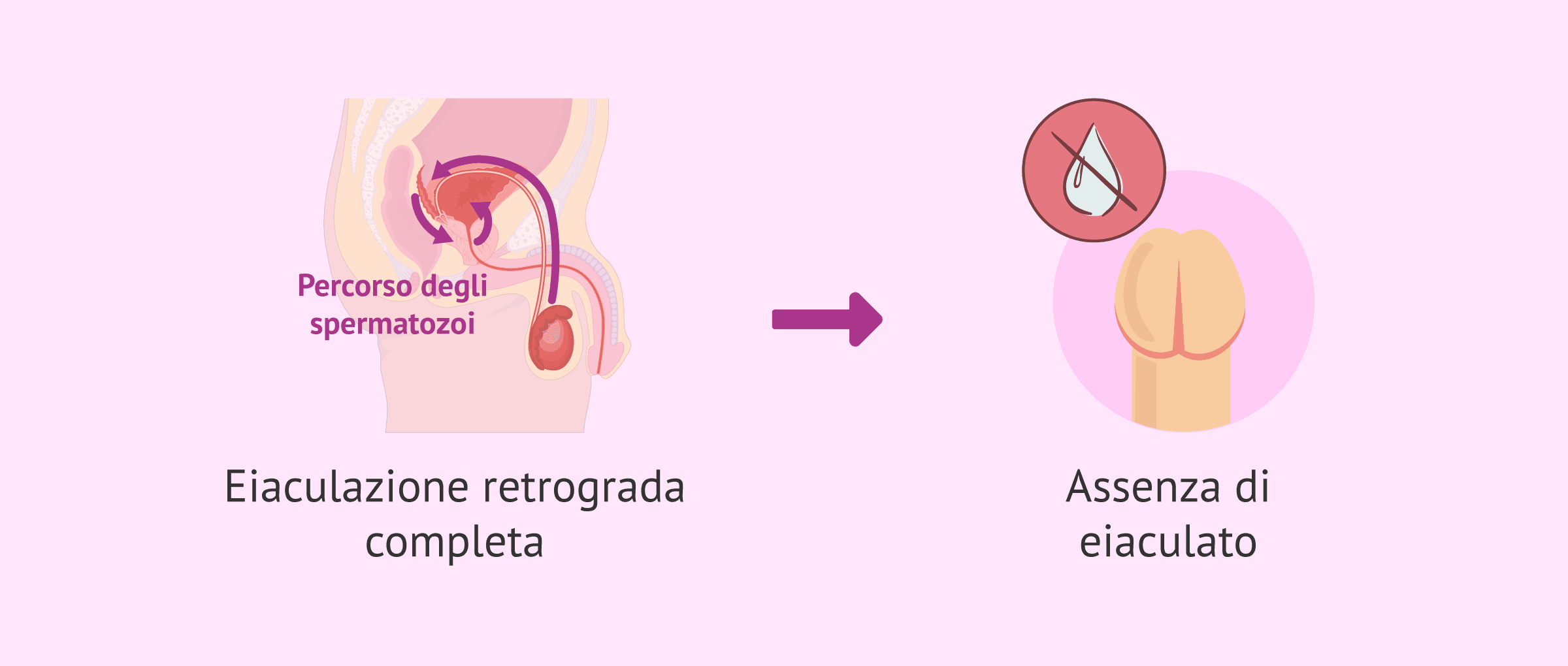 Imagen: Conseguenze dell'eiaculazione retrograda completa