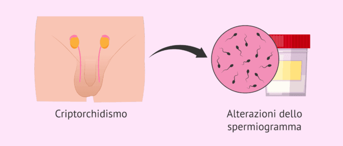Imagen: Il criptorchidismo influisce sulla fertilità maschile?