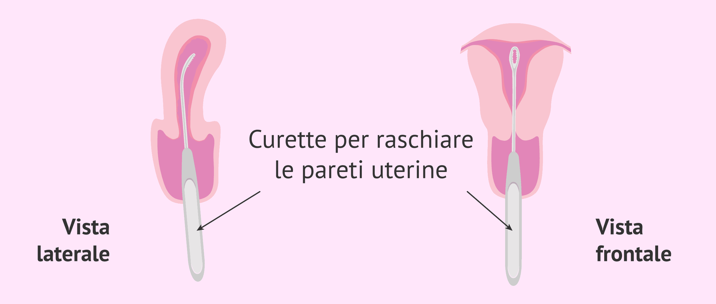 Imagen: Raschiatura o curettage delle pareti uterine
