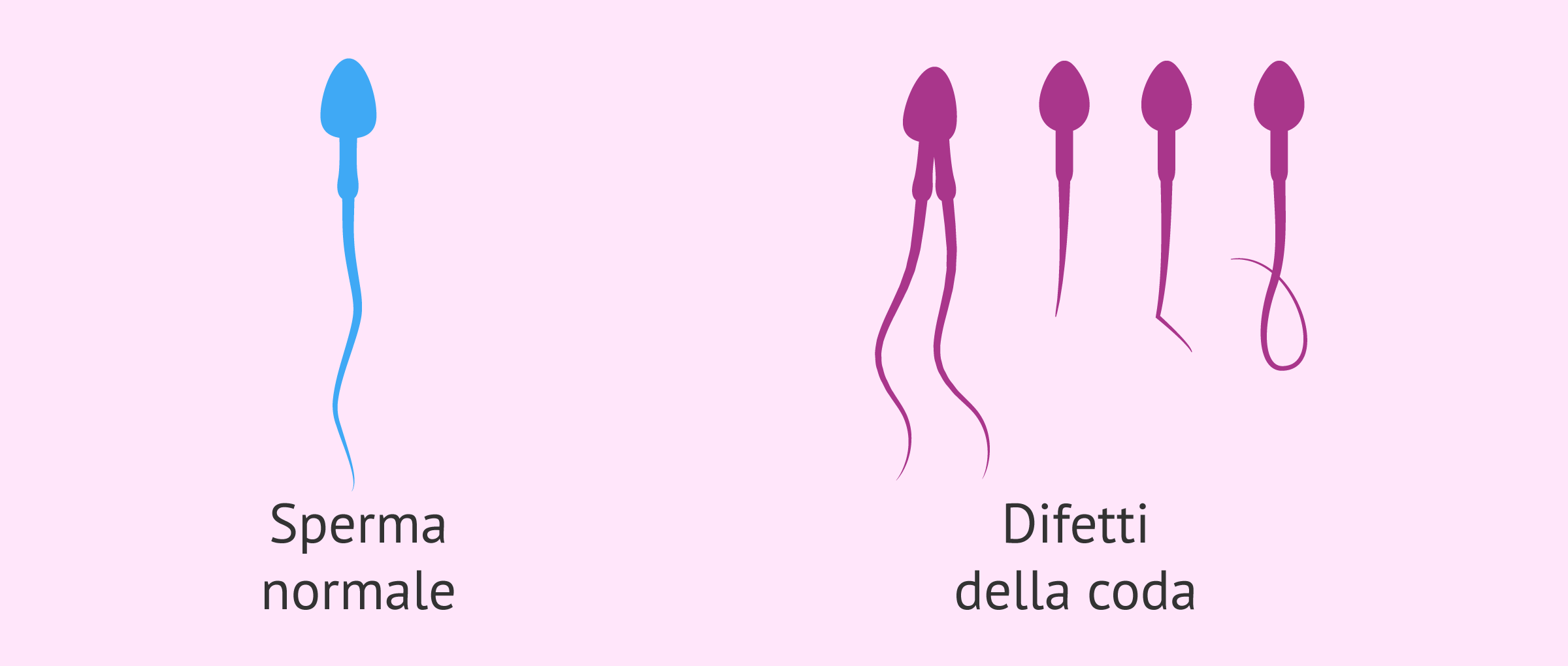 Difetti nella coda dello sperma
