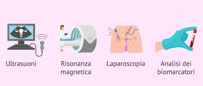Imagen: Diagnosi di endometriosi