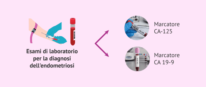 Imagen: Analisi dei marcatori tumorali nella diagnosi dell'endometriosi