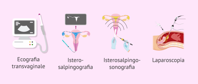 Imagen: Come si diagnostica il fattore tubarico?