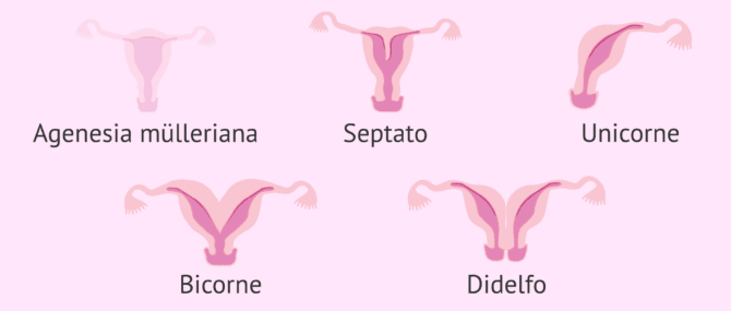 Imagen: Diverse malformazioni uterine