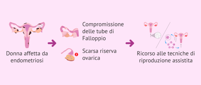 Imagen: Impatto dell'endometriosi sulla fertilità