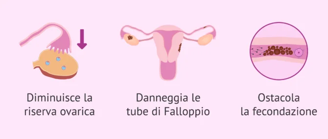 Imagen: Quali effetti ha l'endometriosi sulla fertilità?