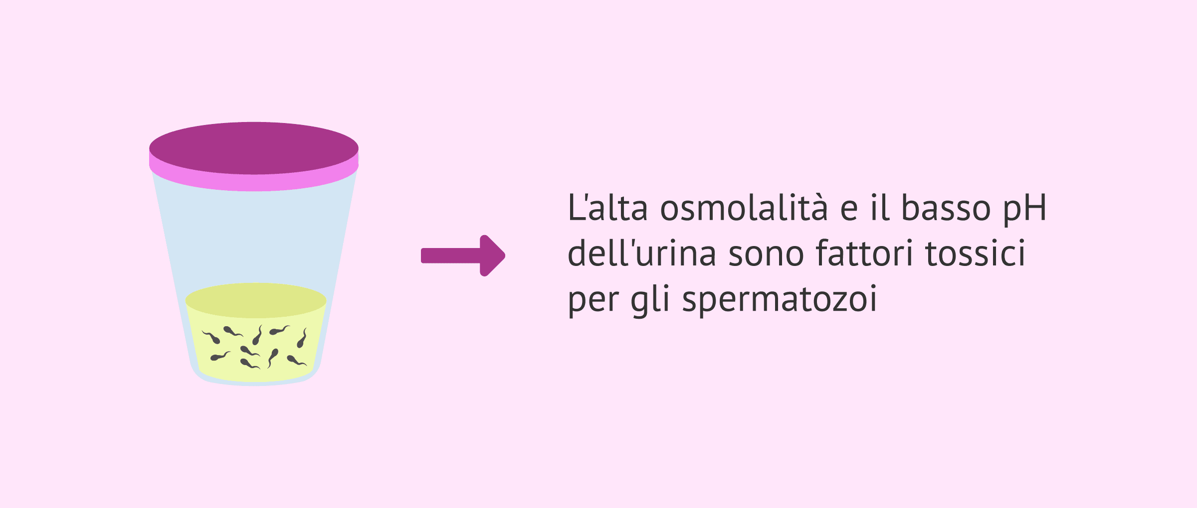 Imagen: Spermatozoi nell'urina dopo eiaculazione retrograda