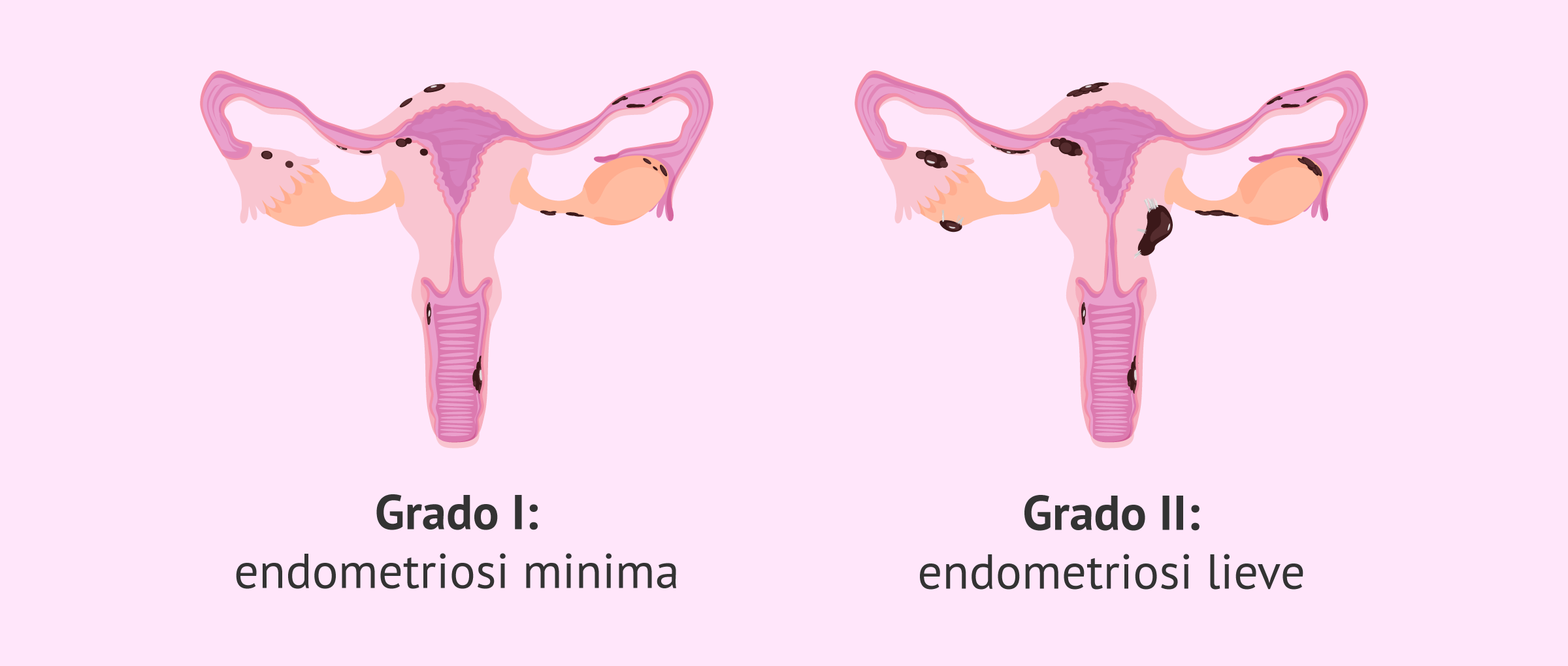 Endometriosi di grado I e II