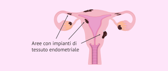 Imagen: Aree dell'apparato riproduttivo colpite dall'endometriosi