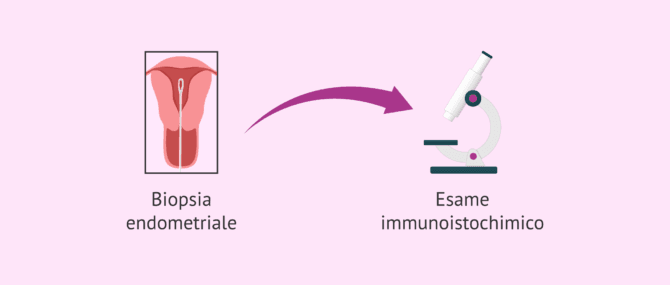 Imagen: Problemi per la diagnosi dell'endometrite cronica