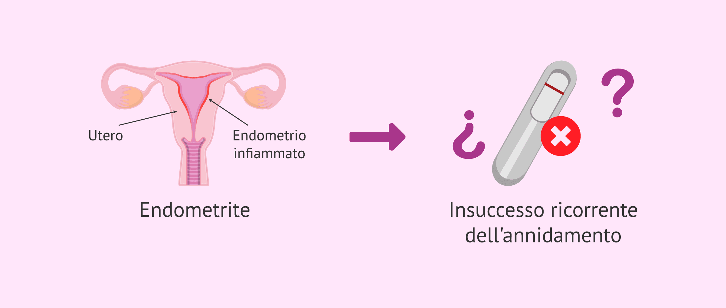 Endometrite cronica: la grande verità sul fallimento dell'impianto