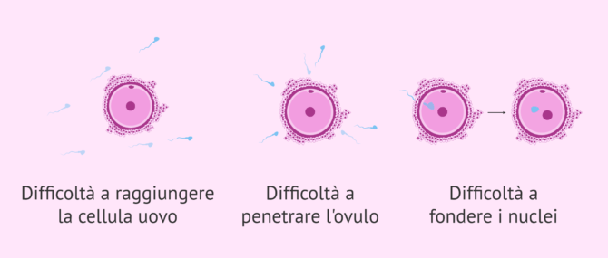 Imagen: Teratozoospermia e fallimento della fecondazione