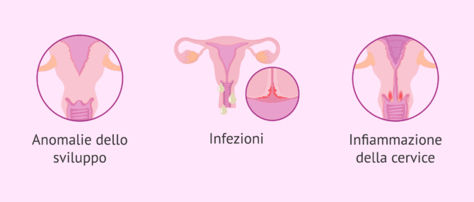 Imagen: Infertilità femminile per fattore cervicale