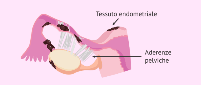 Imagen: Fattore tubarico da endometriosi