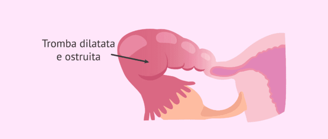 Imagen: Fattore tubarico da idrosalpinge