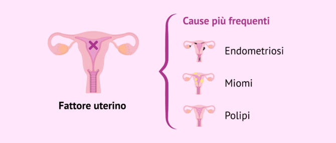 Imagen: Principali cause dell'infertilità femminile per fattore uterino