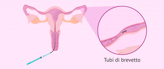 Imagen: Fecondazione dell'uovo nelle tube di Falloppio