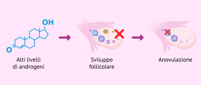 Imagen: Fertilità nelle donne con PCOS