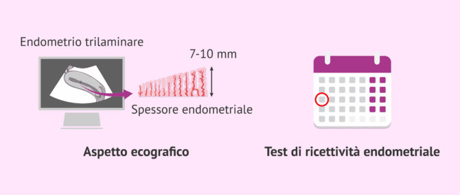 Imagen: Valutazione ecografica dell'endometrio e finestra di impianto