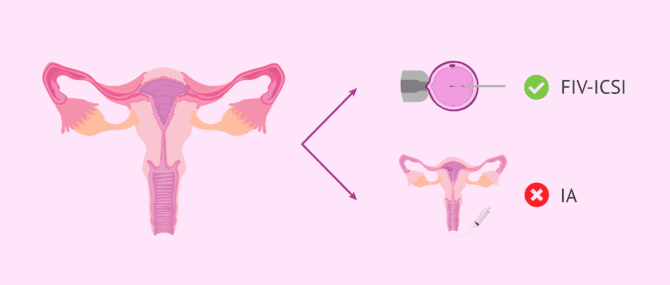 Imagen: Gravidanza con salpingite