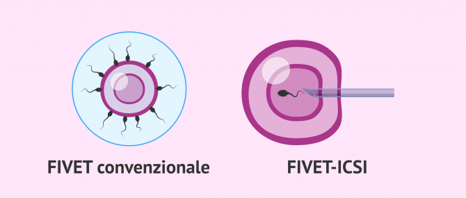 Imagen: FIVET convenzionale - ICSI