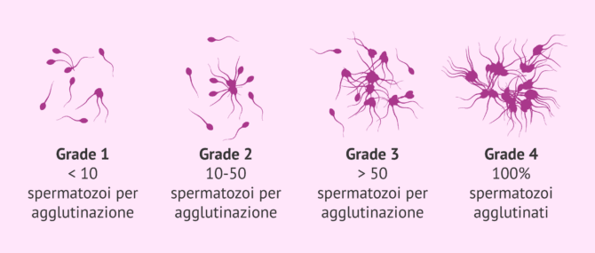 Imagen: Differenti gradi di agglutinazione degli spermatozoi