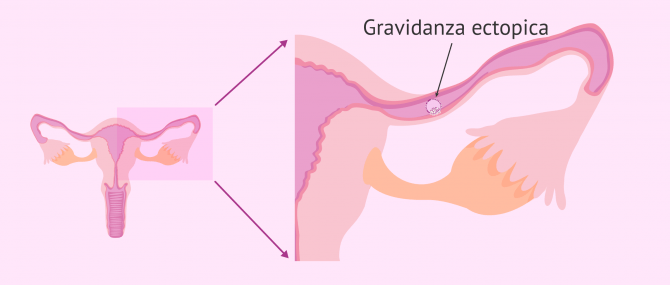 Imagen: Gravidanza ectopica nell'inseminazione artificiale