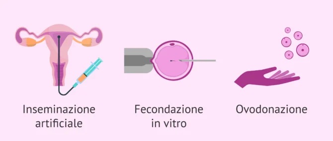 liquido nel douglas e endometriosi Cos'è l'endometriosi?
