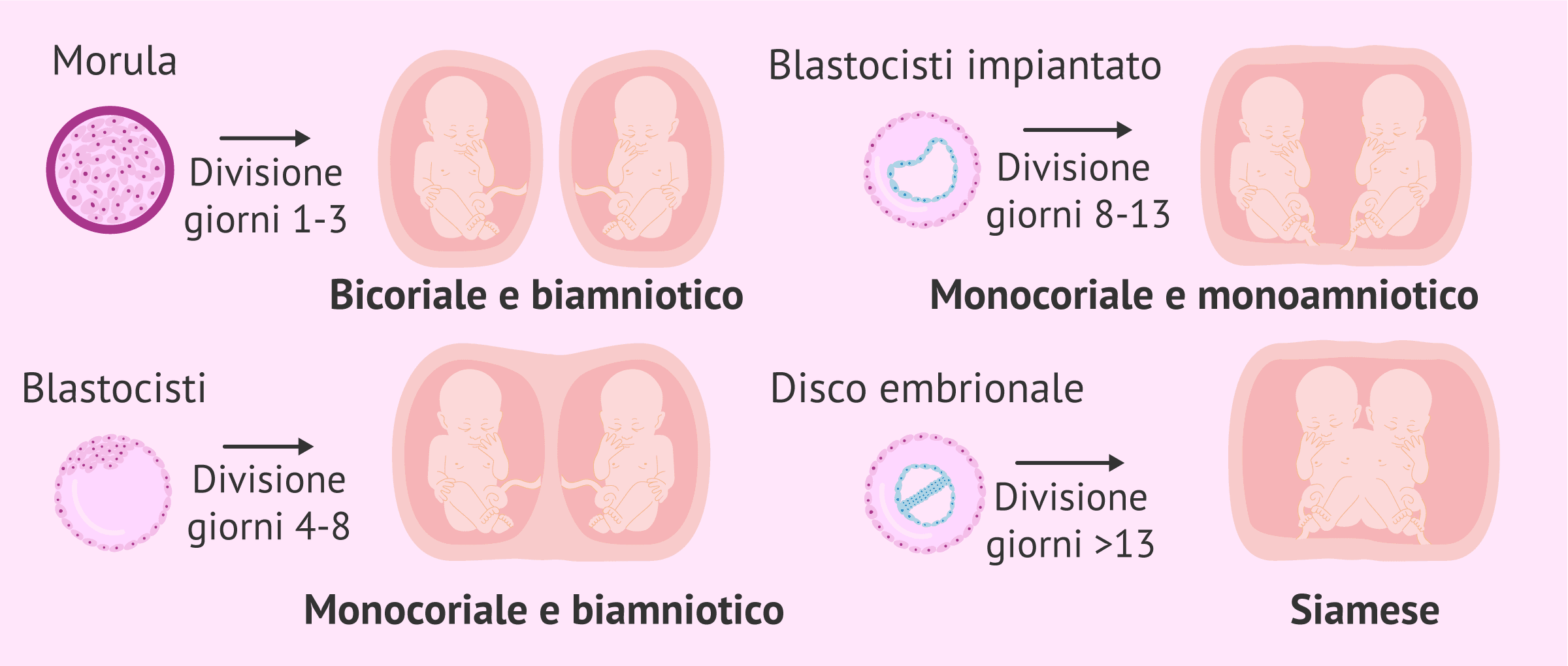 Imagen: Tipi di gemelli monozigoti