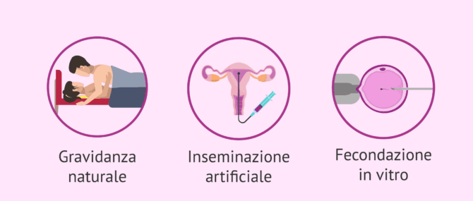 Imagen: Fattore tubarico unilaterale e possibilità di gravidanza