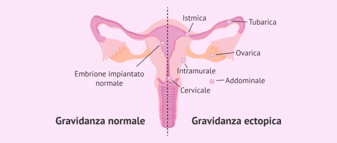 Imagen: Gravidanza normale vs gravidanza ectopica