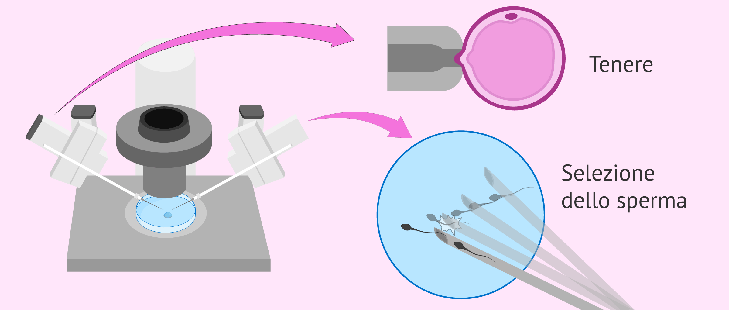 Preparazione di ovuli e spermatozoi per l'ICSI