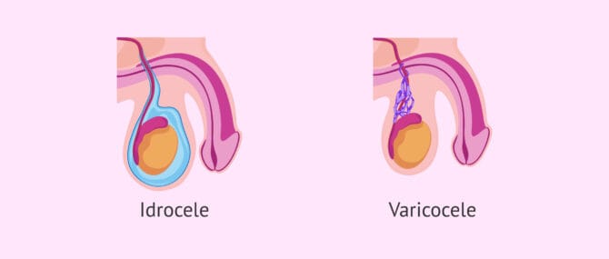 Imagen: Differenze tra idrocele e varicocele
