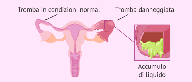 Imagen: Tuba normale e tuba affetta da idrosalpinge