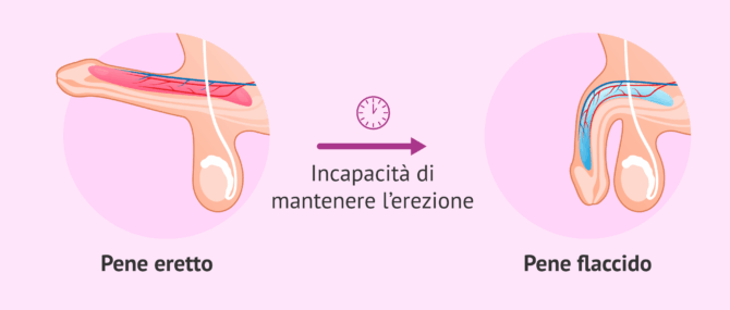 Imagen: Che cos'è l'impotenza sessuale?