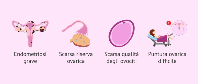 Imagen: Indicazioni per l'ovodonazione nelle donne con endometriosi