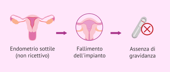 Imagen: Quando è indicato lo scratching endometriale?