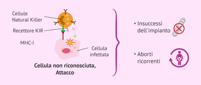Imagen: Infertilità aloimmune dovuta a livelli elevati di cellule NK